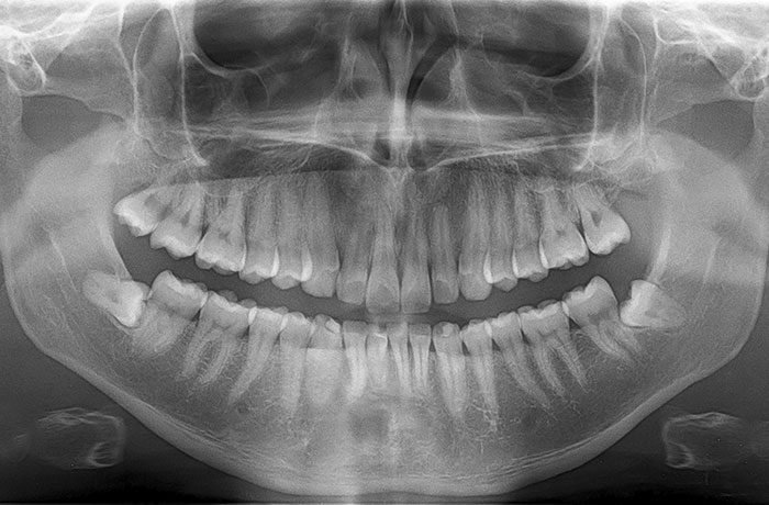 Wisdom Teeth Williams Landing