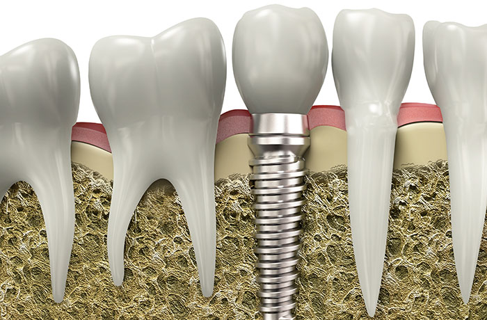Dental Implants Williams Landing