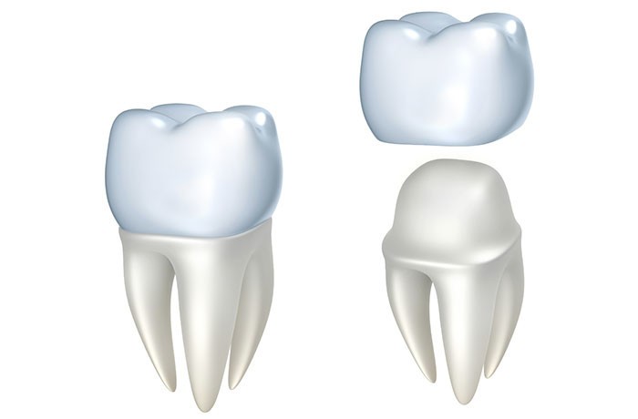 Example of some of our crown veneers in Truganina