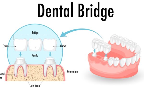 Crown Veneers and Bridges in Williams Landing