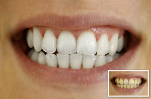 Before and after photos for teeth whitening in Truganina and Hoppers Crossing