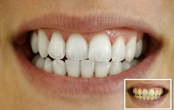 In Chair Tooth Whitening