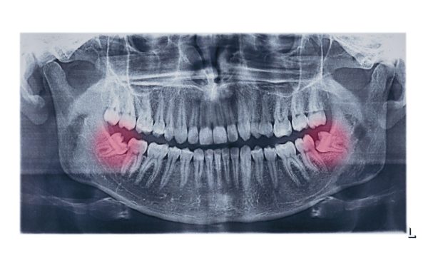 Wisdom Teeth Removal