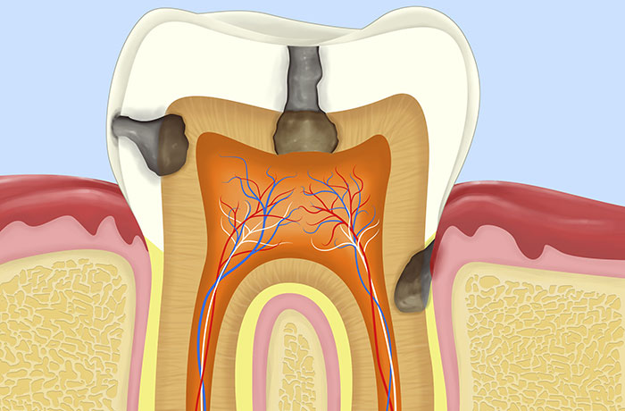 root canal treatment